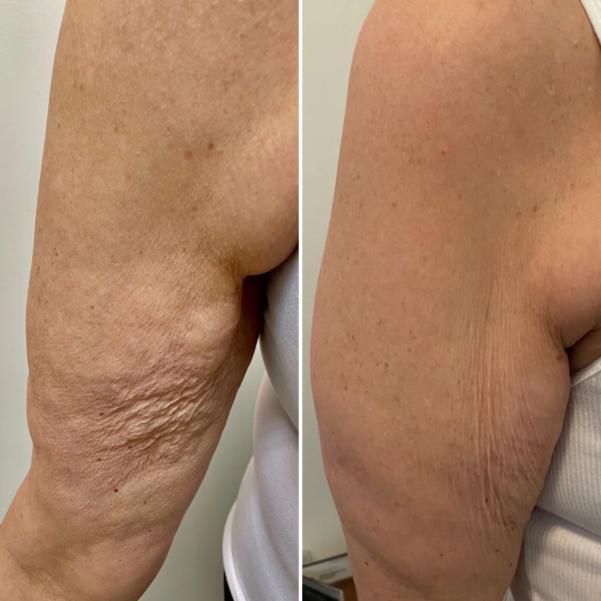 Morpheus8 body arms skin tightening before and after results