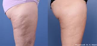 Morpheus8 body legs cellulite reduction before and after results
