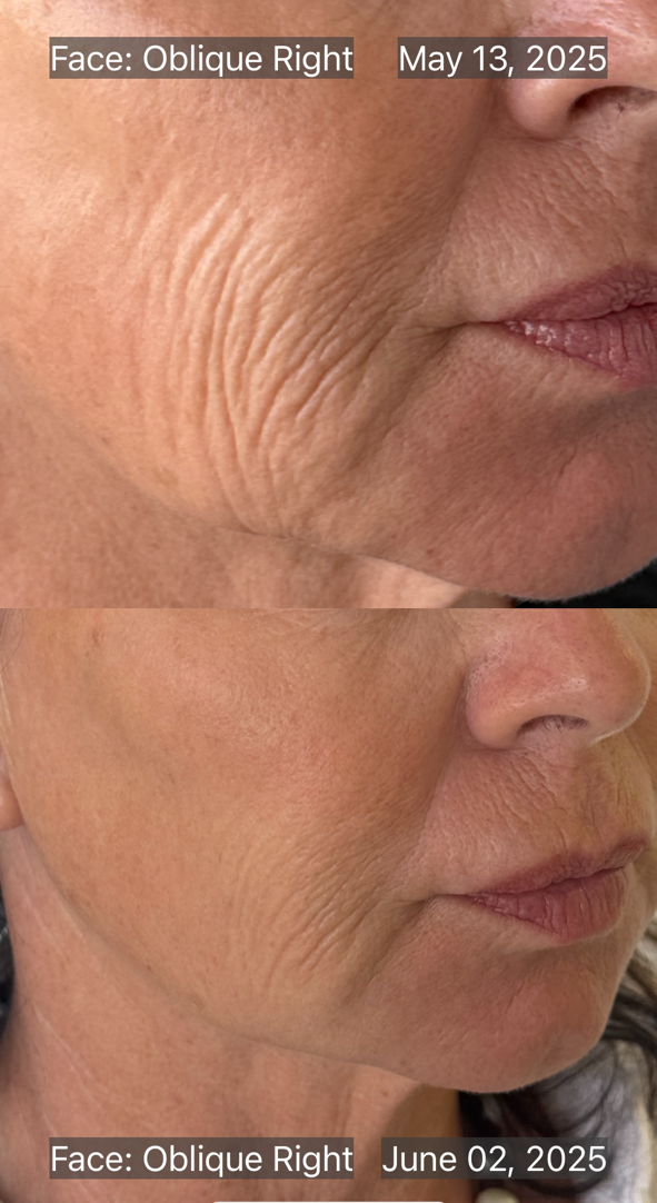 Morpheus8 face treatment before and after results