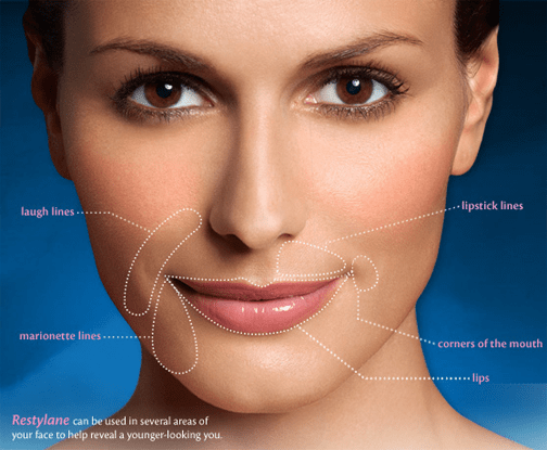 Dermal filler treatment areas