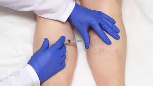 Sclerotherapy procedure at MED SPA ON 5TH