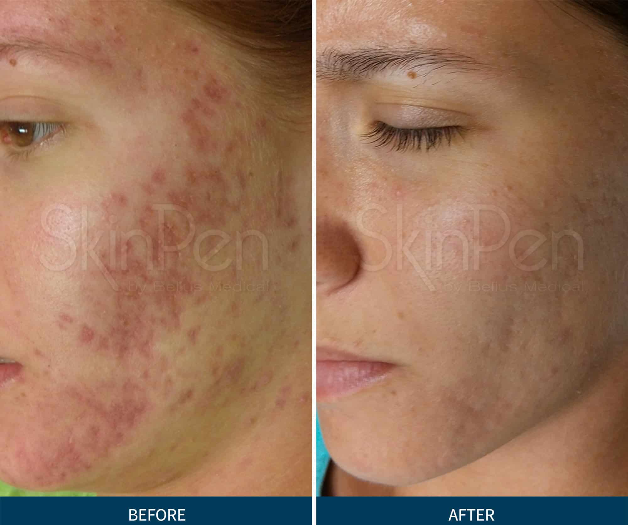 SkinPen acne scar treatment before and after results showing significant improvement in skin texture and scarring
