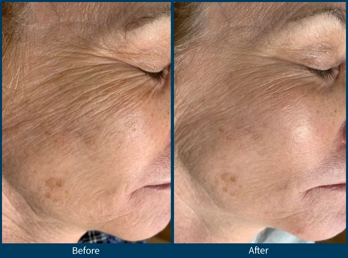 SkinPen before and after results showing dramatic improvement in fine lines and wrinkles around the eye area