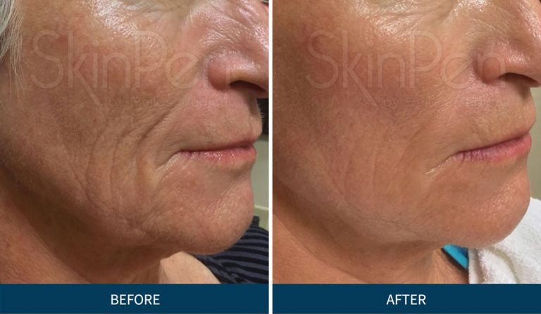 SkinPen fine lines and wrinkles improvement showing smoother skin texture and reduced aging signs