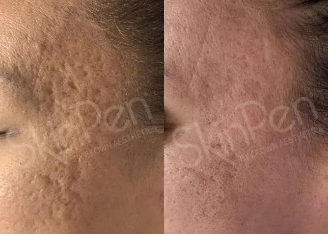 SkinPen temple acne scar improvement showing dramatic reduction in deep pitted scarring