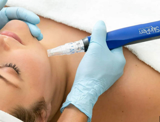 SkinPen microneedling treatment