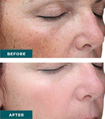 VI Peel before and after results showing improved skin tone and texture